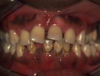 image of severe periodontitis
